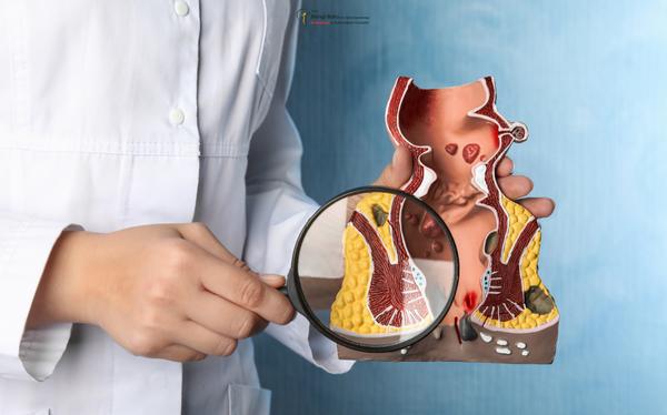 Anal Fistülde Seton Uygulaması Antalya