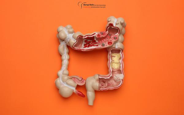 Kalın Bağırsak Kanseri Ameliyatı - Cerrahisi Antalya